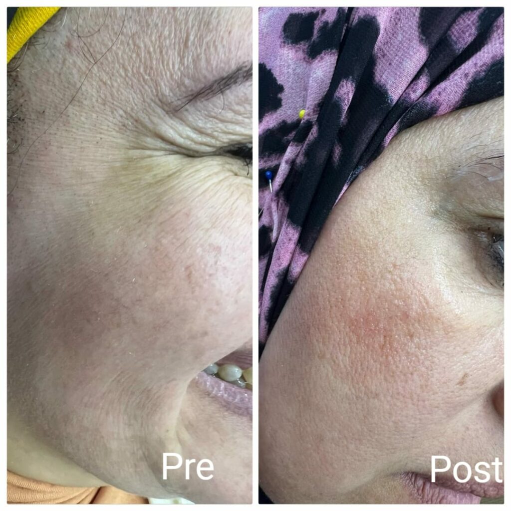 Treating wrinkles under the eyes